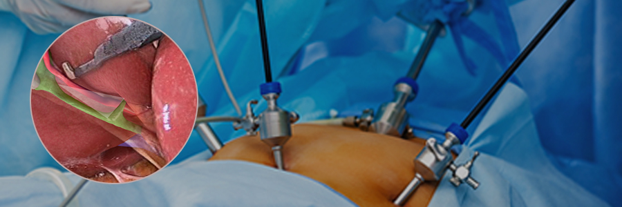 Laparoscopic Surgery